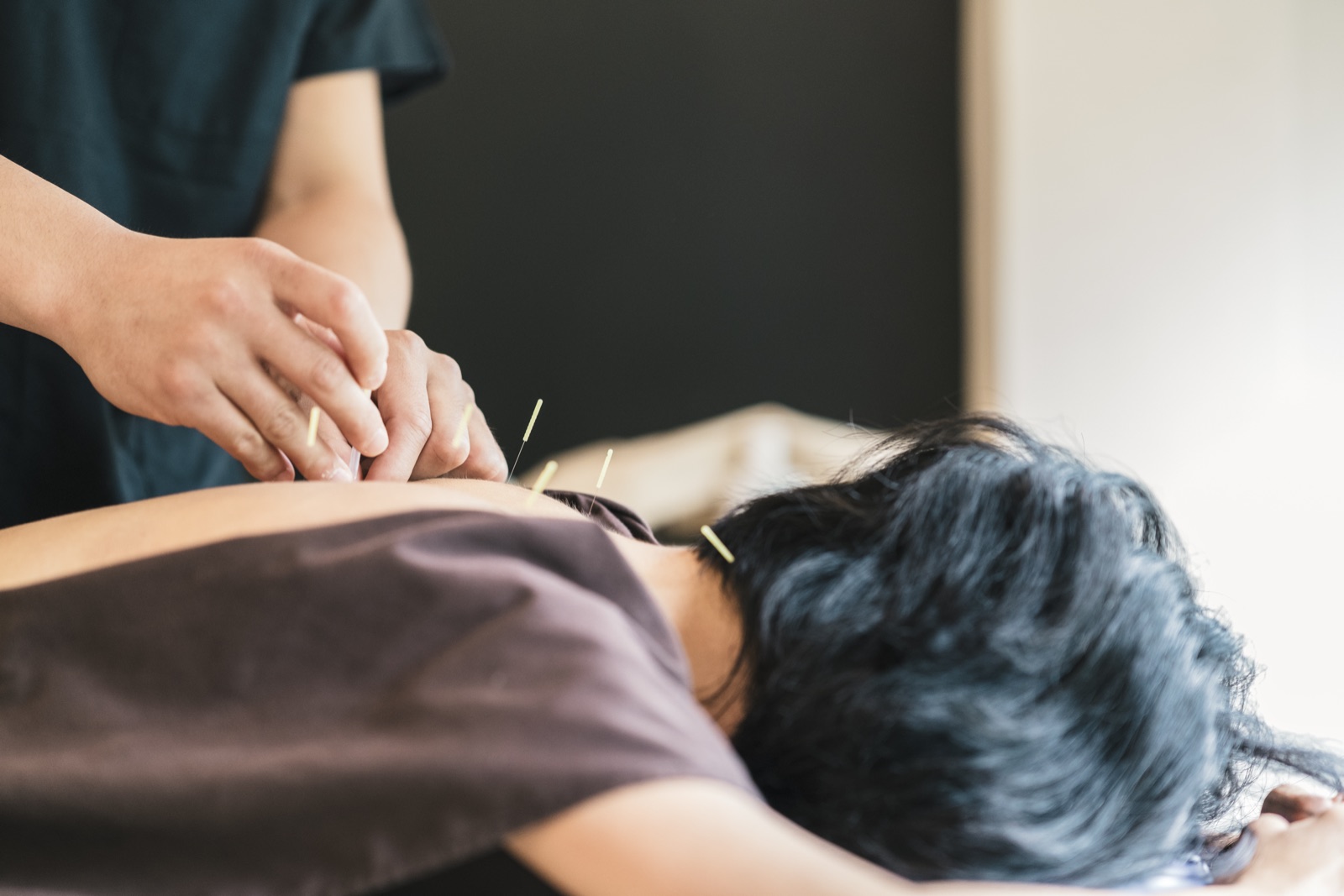 An acupuncture session shown for illustration — stock photograph